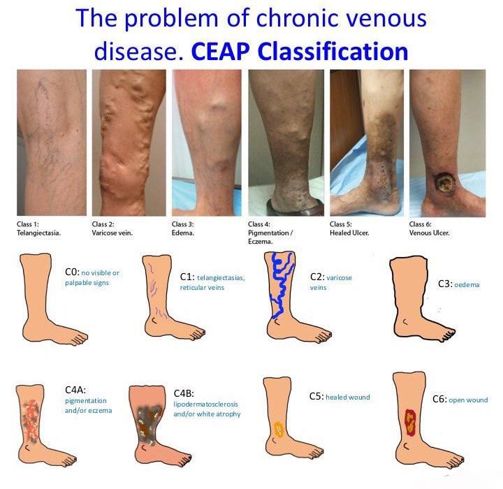Стадії венозної недостатності CEAP classification